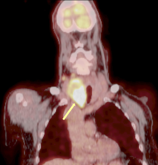 Thyroid angiosarcoma: a rare malignancy - case report and systematic review of the literature.