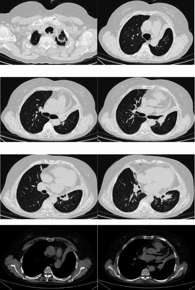 A case of tracheobronchomegaly misdiagnosed as COPD: case report and literature review.
