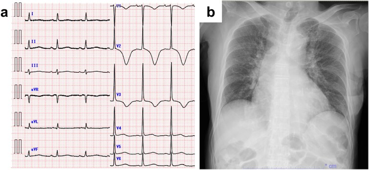 Successful fluoroquinolone-based salvage therapy in the conservative management of refractory infective endocarditis caused by <i>Streptococcus anginosus</i> in an elderly patient: a case report.
