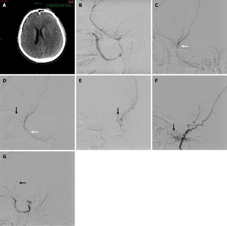 Diplopia after middle meningeal artery embolization for chronic subdural hematoma: A case report.