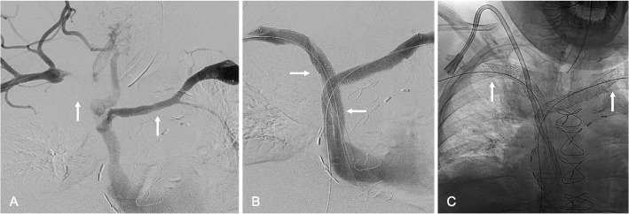 Dedicated venous stent placement across the thoracic outlet: will novel venous stents transform axillosubclavian vein thrombosis treatment paradigm?