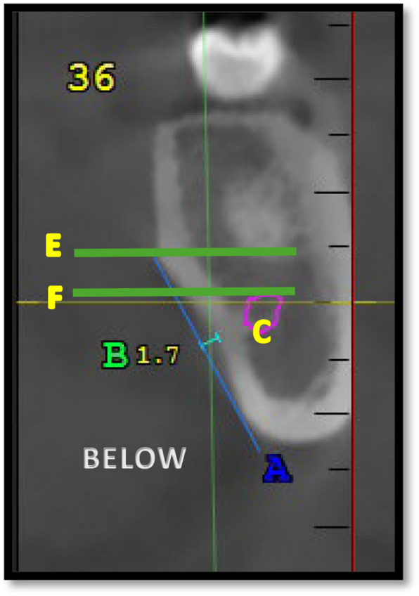 Assessment of the submandibular fossa depth and diameter of the mandibular canal via cone beam computed tomography: a comparative study.