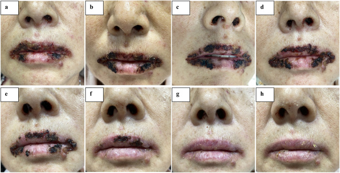 Upadacitinib Coadministered with Methylprednisolone for Effective Treatment of SJS/TEN Overlap Syndrome: A Case Report.