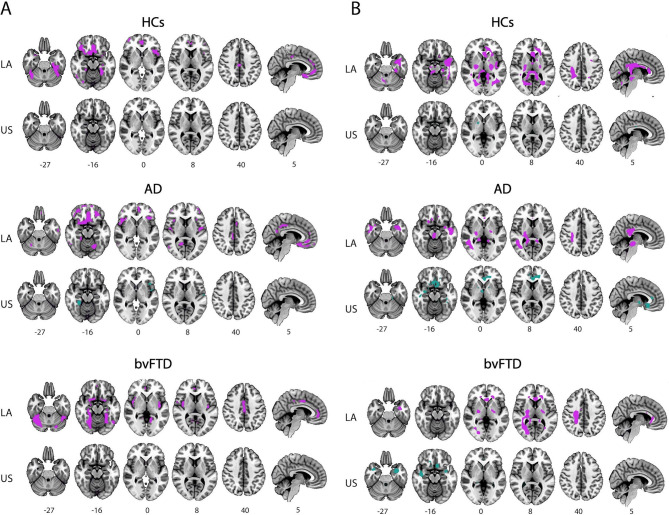 White matter hyperintensities and their impact in brain structure and function in alzheimer's disease and behavioral variant frontotemporal dementia across Latin America and the United States: a cross-sectional study.