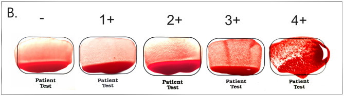 Prevalence of Dal blood type and dog erythrocyte antigens 1 and 4 among canine blood donors and recipients in Seoul, South Korea.