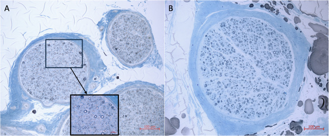 Random X chromosome inactivation in female Charcot-Marie-Tooth disease type X1: insights from sural nerve biopsy analysis.
