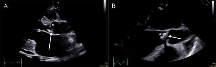 <i>Bartonella</i> endocarditis: a complex diagnosis of blood culture-negative endocarditis in an endemic region of Africa.