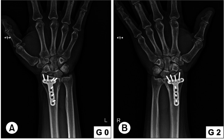 The Impact of Sigmoid Notch Involvement on the Outcomes of Distal Radius Fractures: Radiological and Clinical Assessments after a Minimum of 5 Years of Follow-up.