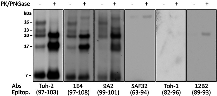 Variably protease-sensitive prionopathy: mass spectrometry analysis of the pathogenic prion protein provides a new perspective.