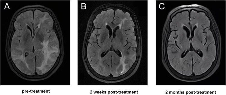 Cerebral Amyloid Angiopathy-Related Inflammation: Clinical Characteristics and Treatment Experience.