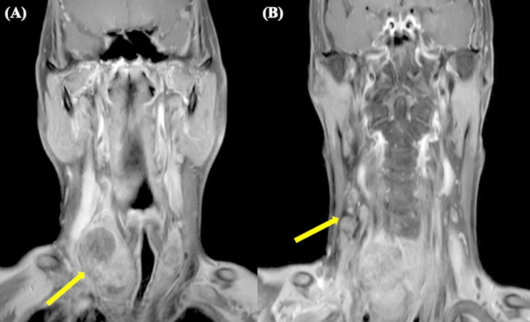 Thyroid angiosarcoma: a rare malignancy - case report and systematic review of the literature.