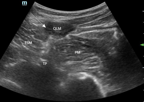 Impact of Posterior Quadratus Lumborum Block on Acute Pain Relief and Chronic Pain Prevention in Breast Cancer Surgery.