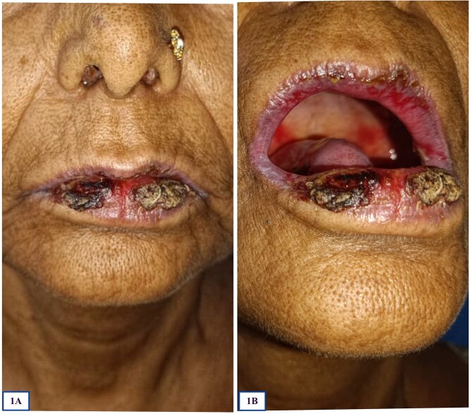 From oral erosions to lymphoma: a case of paraneoplastic pemphigus with occult lymphoma.
