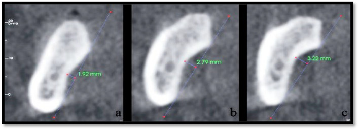 Assessment of the submandibular fossa depth and diameter of the mandibular canal via cone beam computed tomography: a comparative study.