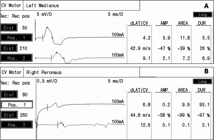 Random X chromosome inactivation in female Charcot-Marie-Tooth disease type X1: insights from sural nerve biopsy analysis.