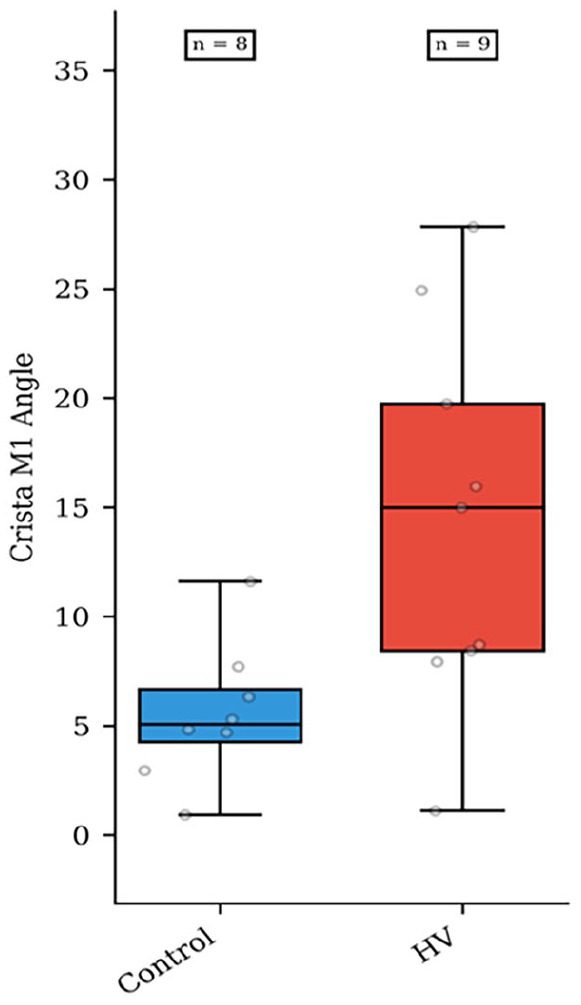 Valgus Deviation of the Intersesamoid Crista in Hallux Valgus and Its Association With the Distal Metatarsal Articular Angle: A Pilot Study.