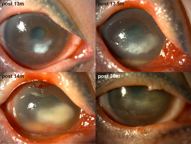 Corneal neurotization meets COVID-19: a case report of minimally invasive corneal neurotization complicated by COVID-19-related keratitis.