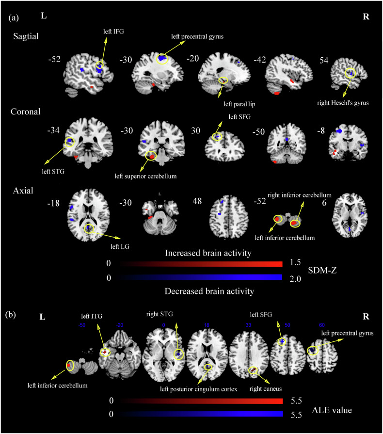 Structural and functional brain abnormal alteration in patients with type 2 diabetes mellitus: A coordinate-based meta-analysis.