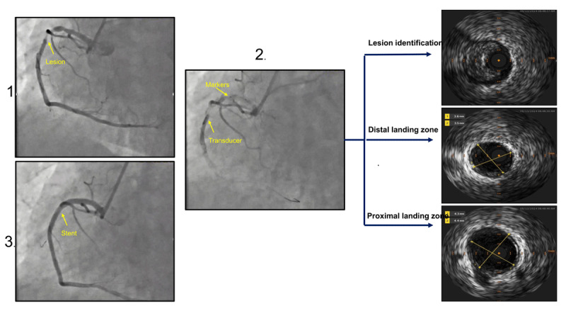 Intravascular Ultrasound Imaging-Guided Percutaneous Coronary Intervention: Evidence and Practical Implications.