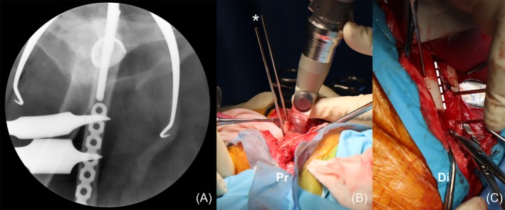Distal femoral shortening osteotomy for managing irreducible hips during total hip replacement in four dogs with severe luxoid hips.