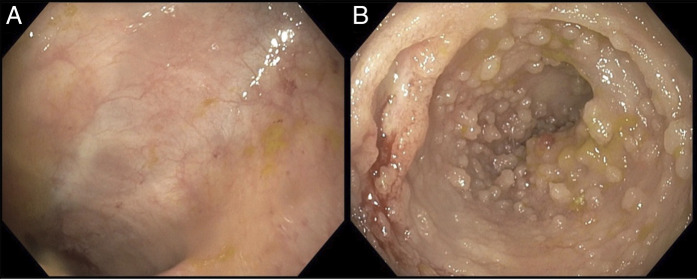 Exacerbation of Crohn's Disease Following Exposure to Anti-OX40 Monoclonal Antibody Therapy.