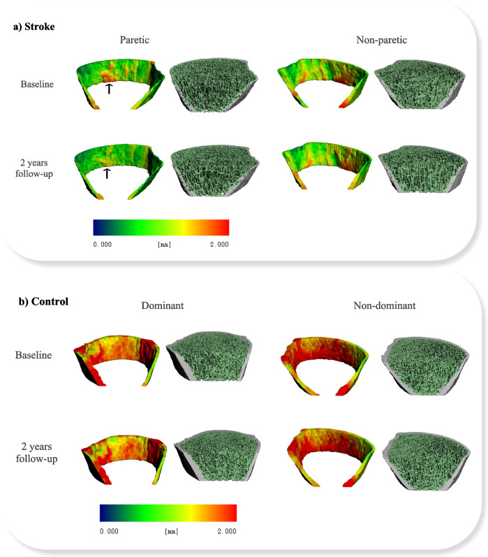 Longitudinal bone loss in the paretic leg and its contributing factors in individuals with chronic stroke: a 2-year prospective cohort study
