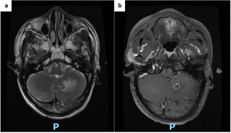 Pulmonary cryptococcosis with headache as the first presentation: A case report.