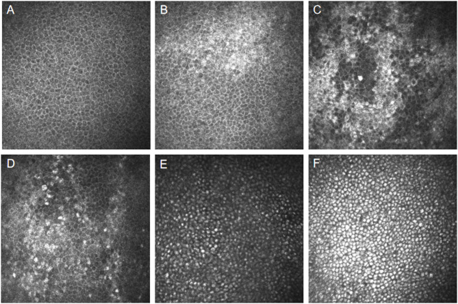 Ocular and confocal manifestations of Mainland Chinese with Fabry disease: a cross-sectional controlled study.