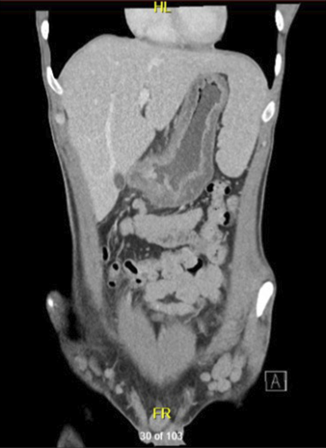 Exacerbation of Crohn's Disease Following Exposure to Anti-OX40 Monoclonal Antibody Therapy.