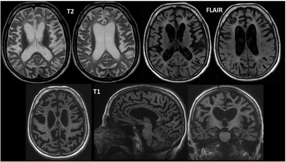 Polycystic lipomembranous osteodysplasia with sclerosing leukoencephalopathy: report of two cases.
