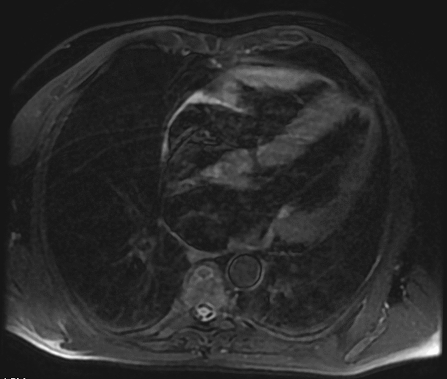 A mutation in transthyretin gene in a Mexican patient leading to hereditary amyloidosis: a case report.