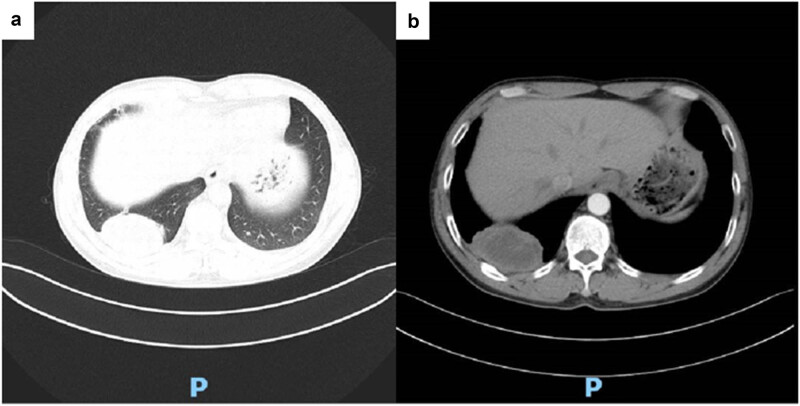 Pulmonary cryptococcosis with headache as the first presentation: A case report.