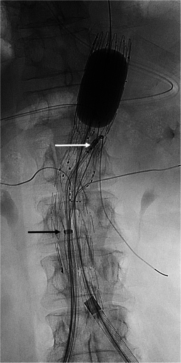 The use of combined fenestrated and bifurcated endografts in fenestrated aortic repair.