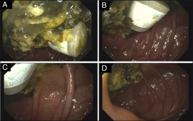 Hidden Hazards: Desiccant Canister Ingestion During Sodium Sulfate Bowel Preparation.