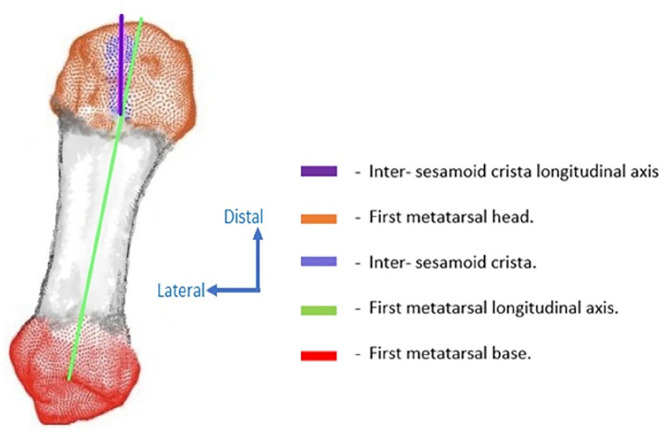 Valgus Deviation of the Intersesamoid Crista in Hallux Valgus and Its Association With the Distal Metatarsal Articular Angle: A Pilot Study.