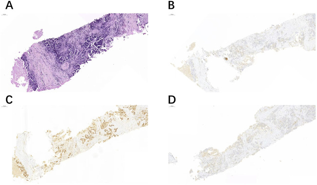 Application of TRPS1 in ER-negative or low expression distant metastatic breast carcinoma.