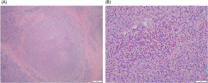 Diagnostic Salivary Gland Biopsy in Pediatric Eosinophilic Granuolmatosis with Polyangiitis.