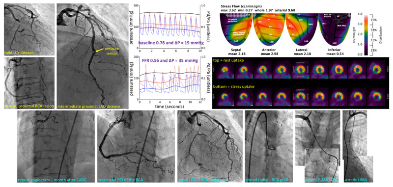 How Different is Invasive Coronary Physiology in the Left Anterior Descending Artery?