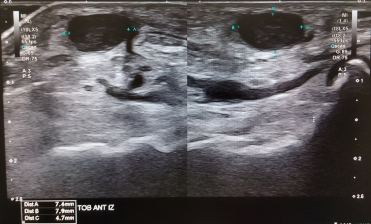[A particular case of a Schwannoma in the foot].