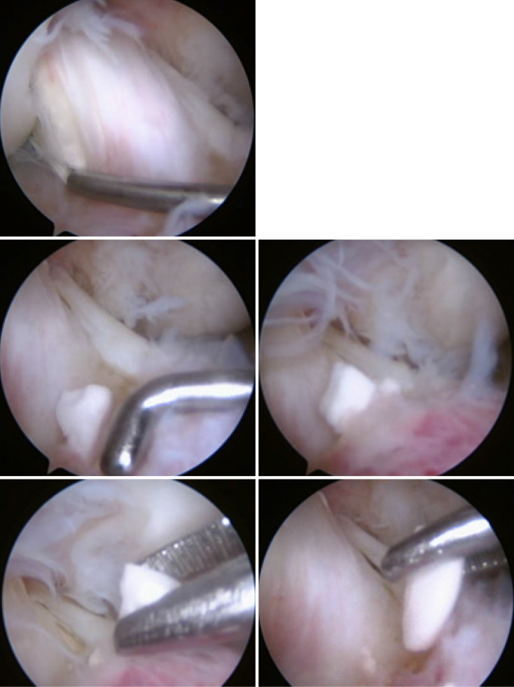 Broken bioabsorbable tibial interference screw post-arthroscopic anterior cruciate ligament reconstruction: A case report.