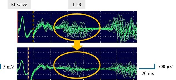 Proprioception and Central Nervous Excitability: Implications for Return-to-Play in Athletes with Ligament or Meniscal Injuries.