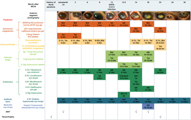 Corneal neurotization meets COVID-19: a case report of minimally invasive corneal neurotization complicated by COVID-19-related keratitis.