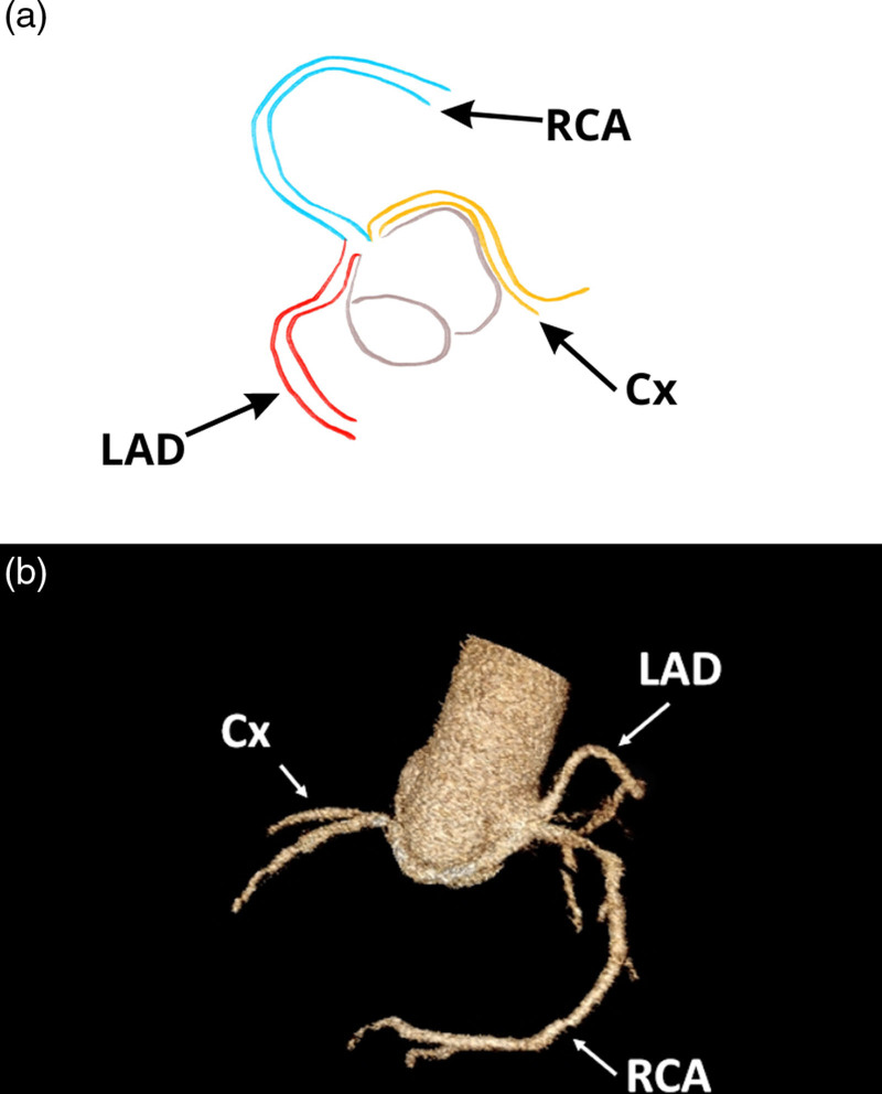 All coronary arteries originating from the right sinus of Valsalva: a multimodality imaging approach.