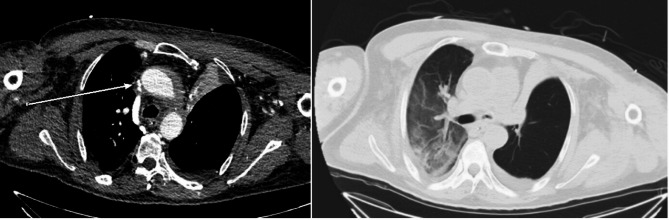 Venovenous extracorporeal membrane oxygenation catheter related superior vena cava syndrome without pre-existing stenosis in an adult patient: a case report.