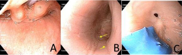 Eosinophilic Esophagitis Complicated by an Esophageal Stricture in a 15-Month-Old Child.