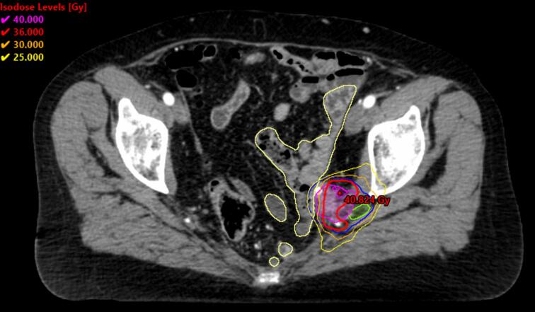 Pelvic stereotactic ablative body radiotherapy (SABR) reirradiation: UK SABR consortium guidance for use in routine clinical care.