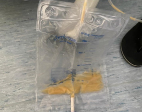 Management of Chyloperitoneum in Laparoscopic Colorectal Surgery for Cancer: A Case Report.