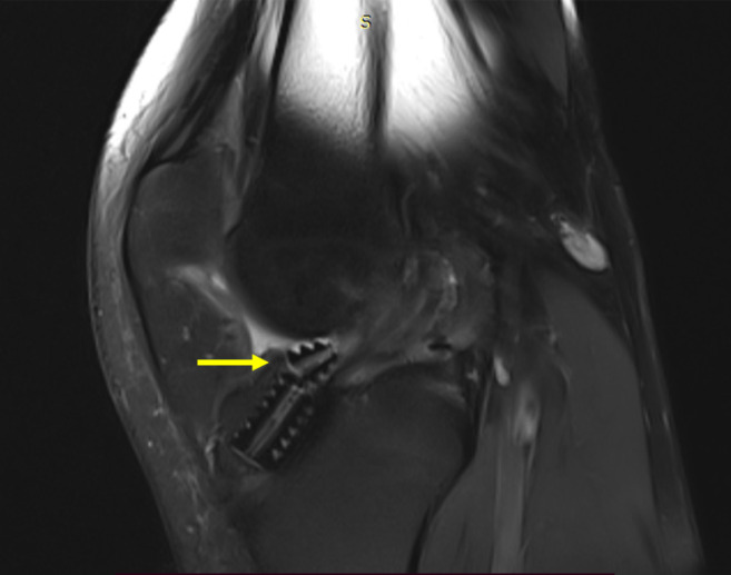 Broken bioabsorbable tibial interference screw post-arthroscopic anterior cruciate ligament reconstruction: A case report.