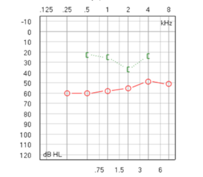 Clinical Audiological Features of Otosclerosis-Preoperative Hearing Analysis in 80 Ears.