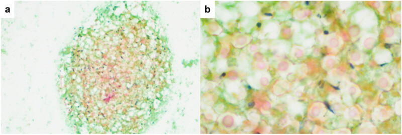 Pulmonary cryptococcosis with headache as the first presentation: A case report.